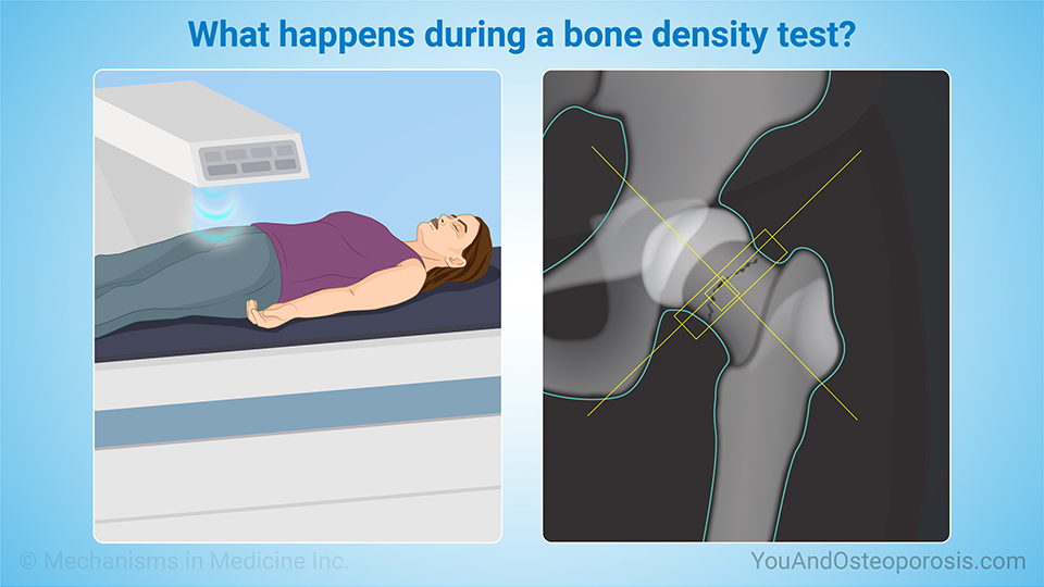 What's your t-score? Bone density scans for osteoporosis - Harvard Health